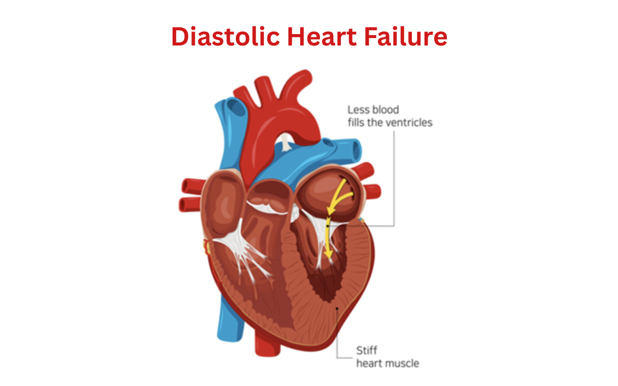 diastolic 