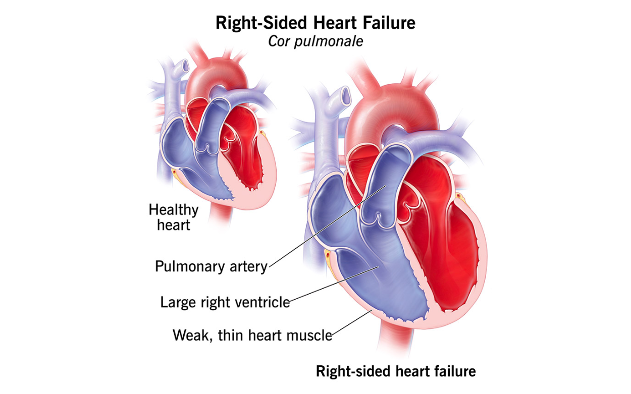 Right sided heart failure