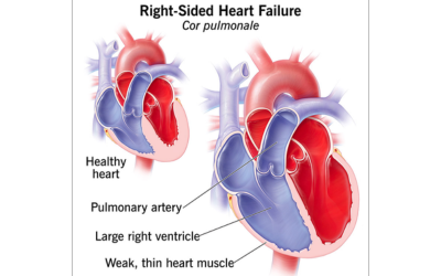 Right-sided heart failure treatment