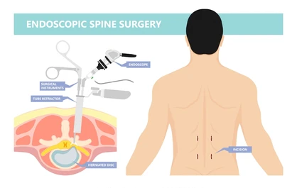 Endoscopic Spine Surgery