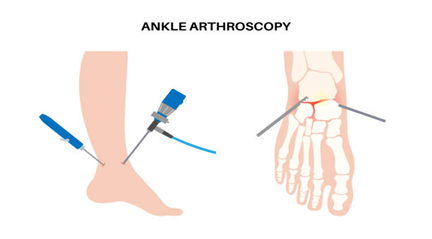 Ankle Arthroscopy Terna Hospital