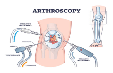 Arthroscopy ACL Reconstruction