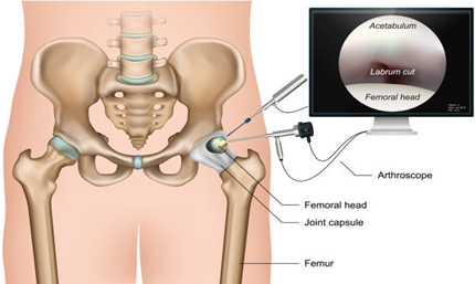 Hip Arthroscopy Terna Hospital