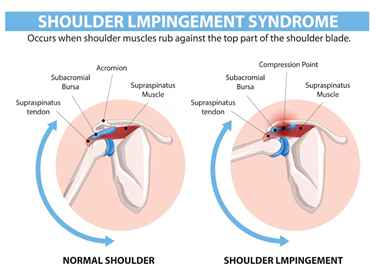 Joint Impingement Syndromes Terna Hospital