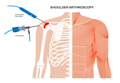Shoulder Arthroscopy Terna Hospital