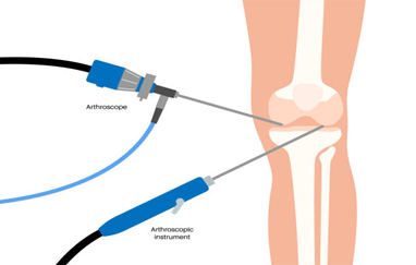 knee arthroscopy Terna Hospital