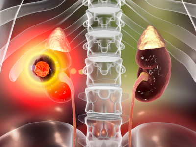 Glomerulonephritis Terna Hospital