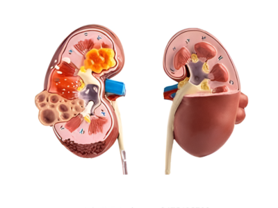 Nephrology Treatment Terna Hospital
