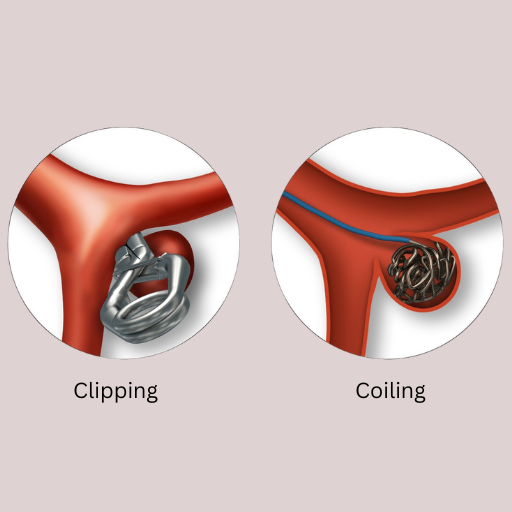 Aneurysm Clipping Coiling