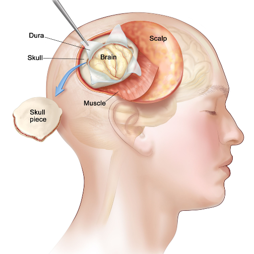 Craniotomy Terna Hospital Craniotomy