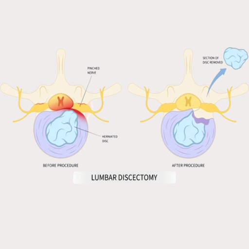 Discectomy Terna Hospital Discectomy