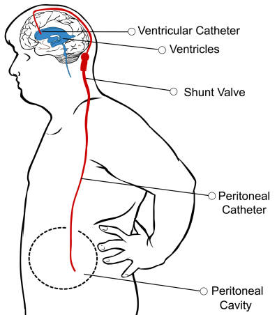 Hydrocephalusshuntplacement