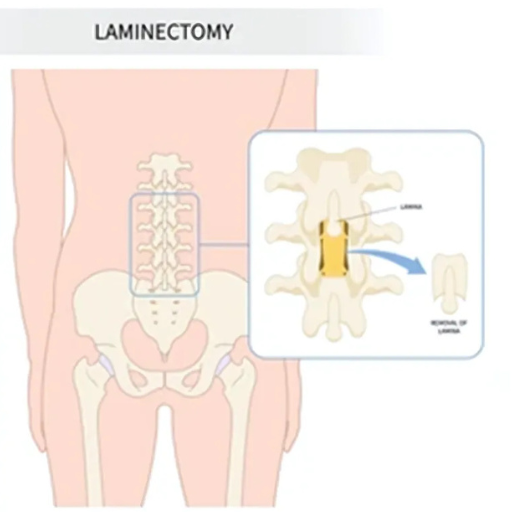 Spinal Fusion Surgery Terna Hospital