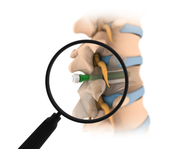 Spinalcordcompressionsurgery