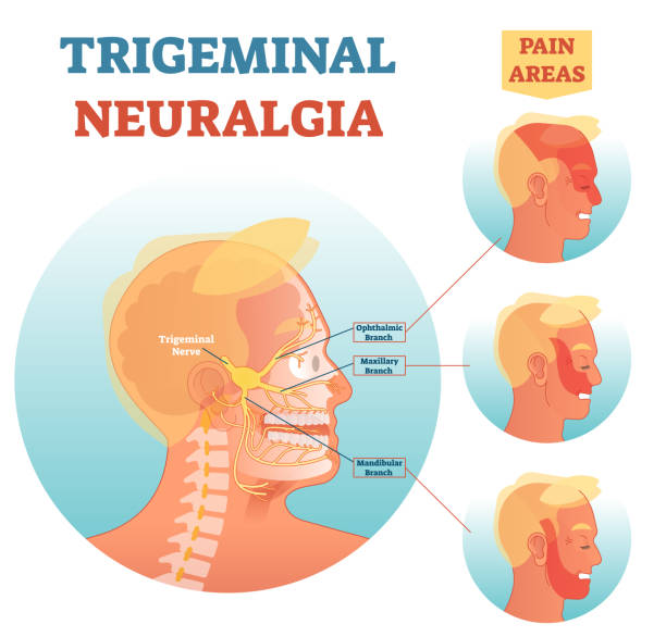 Trigeminalneuralgiasurgery Trigeminal Neuralgia Surgery