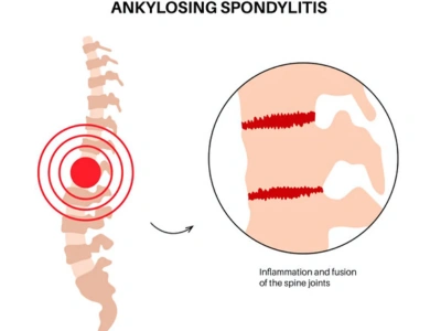 Ankylosing Spondylitis Terna Hospital Intraoperative Neuro Monitoring IONM