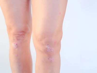 Psoriatic Arthritis Terna Hospital Stereotactic Navigation Systems